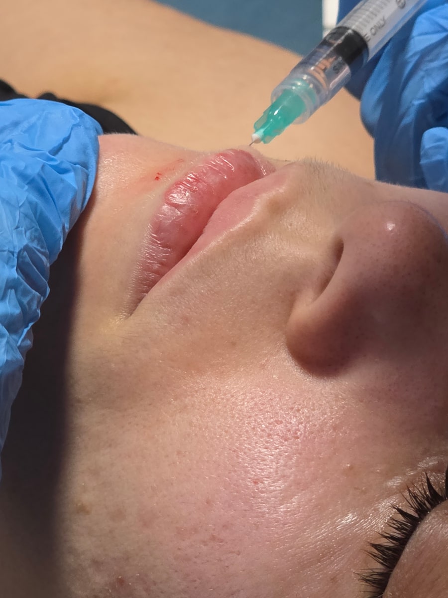 Aplicación de ácido hialurónico en los labios